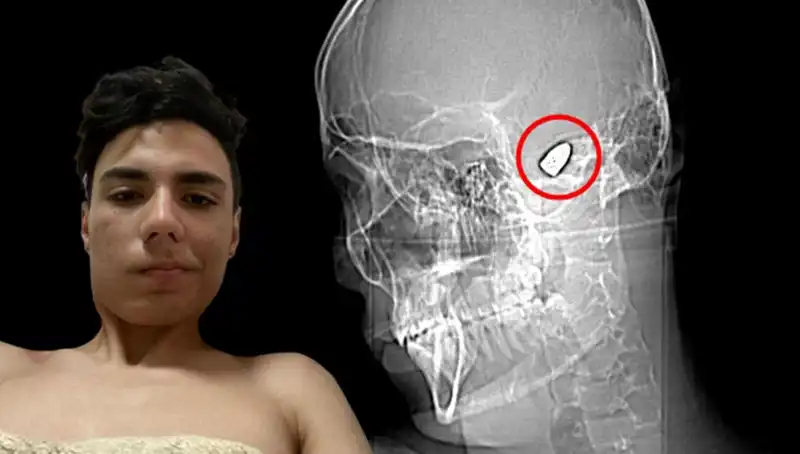 Kafasında Patlamaya Hazır Bomba Taşıyan Genç, Hayatta Kalma Mücadelesi Veriyor